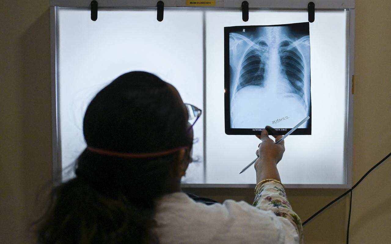 Een dokter van Artsen Zonder Grenzen bekijkt een röntgenfoto van de borstkas van een tbc-patiënt in Mumbai.