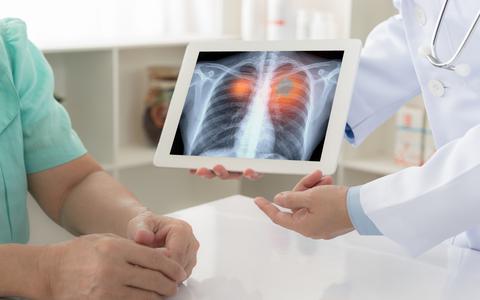 Het vroeg opsporen van longkanker met een CT-scan bij rokers en ex-rokers kan de sterfte aan longkanker met 25 procent of meer omlaag brengen.